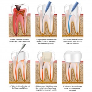 Wurzelbehandlung - root canal treatment with crown